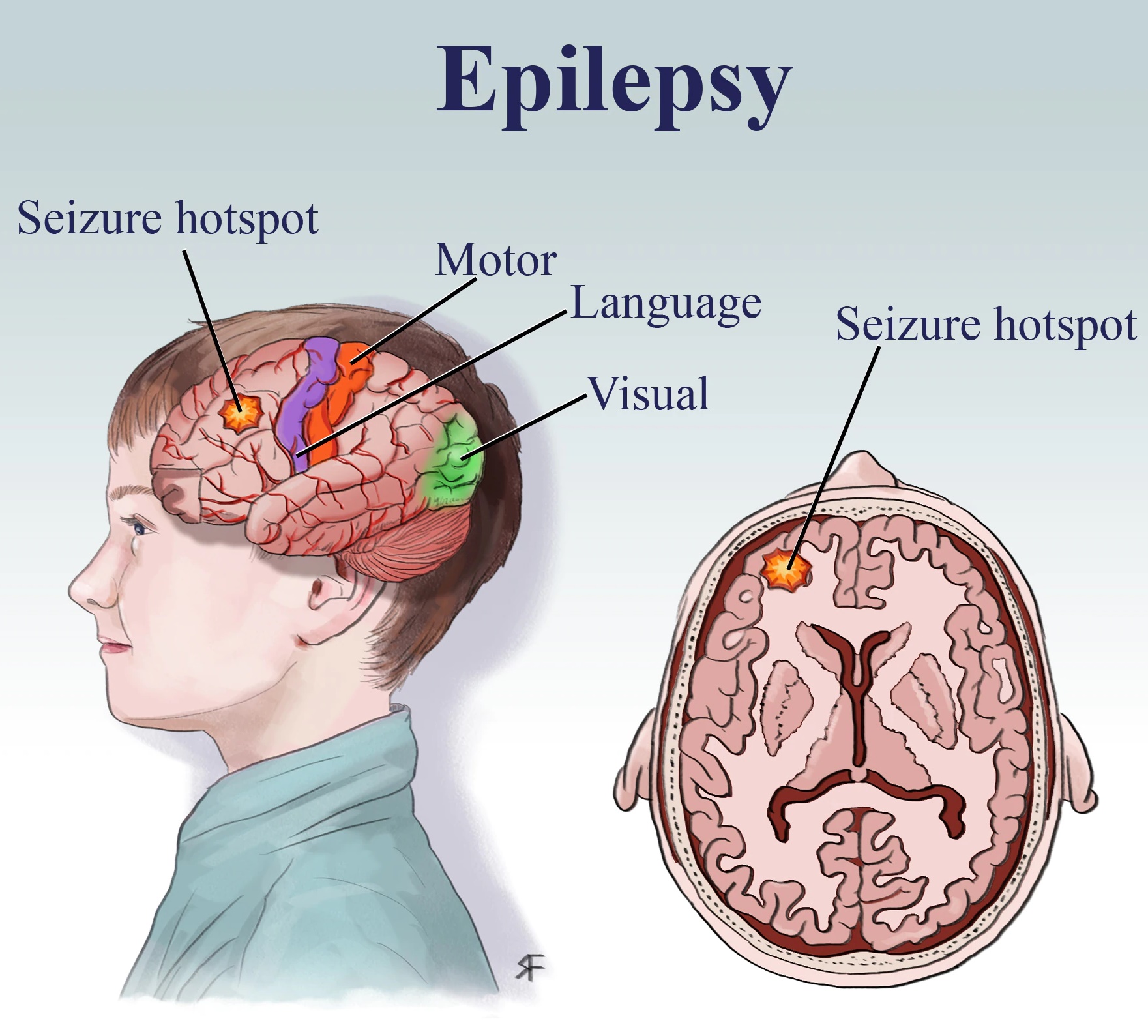 Epilepsy