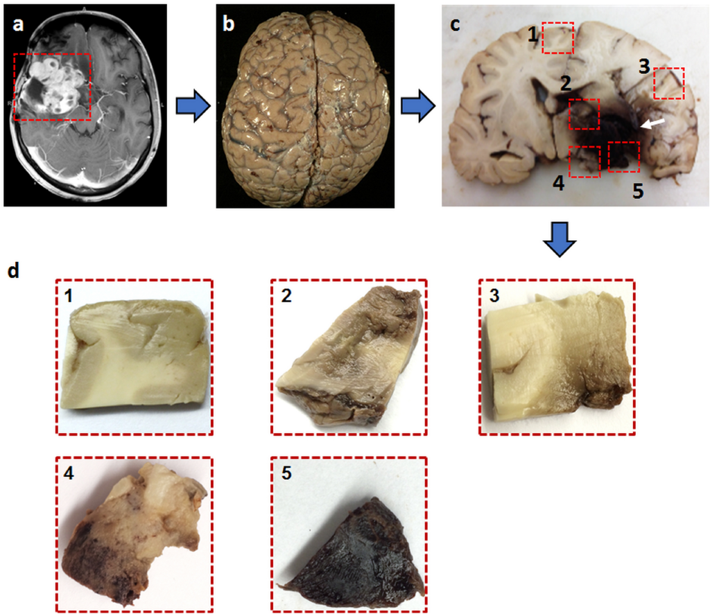 Brain Tumor