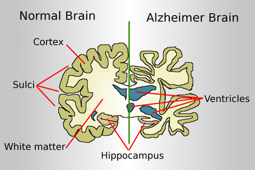 Alzheimer's disease brain parts explain