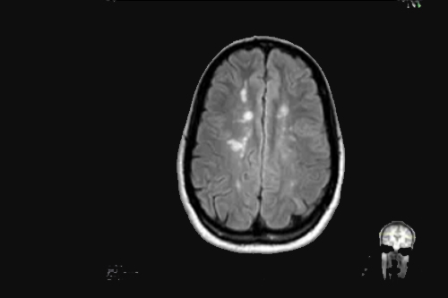 Autoimmune Neurological Disorders brain neurons black img xray