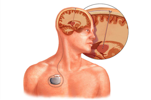 Deep Brain Stimulation Human stimulation brain structure