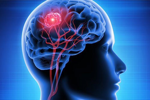 Neurocritical care tumor in brain