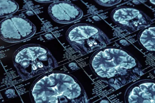 Neuroimaging brain xray img