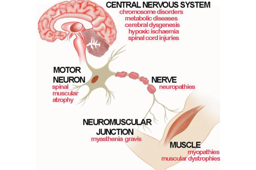 Neuromuscular disorders neurons parts explain