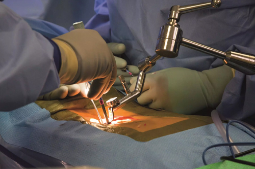 Spinal Surgery opernation performed in OT