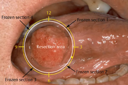 Tumor Resection Surgery explains