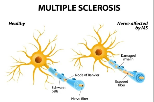 Multiple sclerosis neurons explain