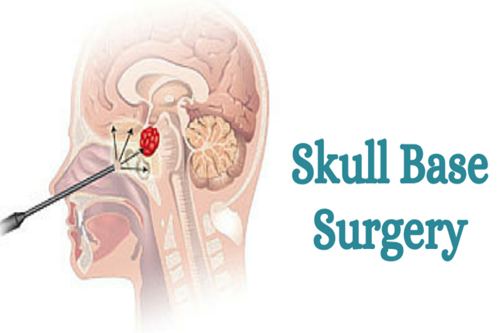 skull base surgery close up img