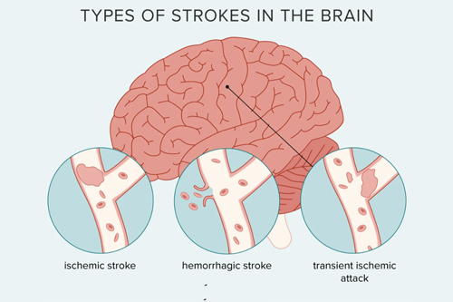 types of 3 strokes explain