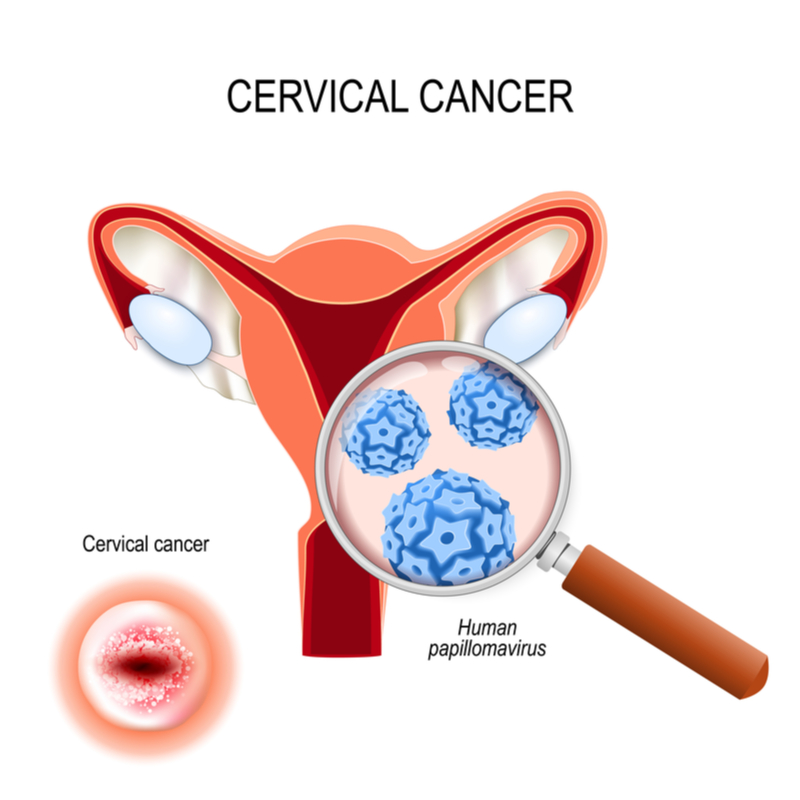 Cervical cancer screening