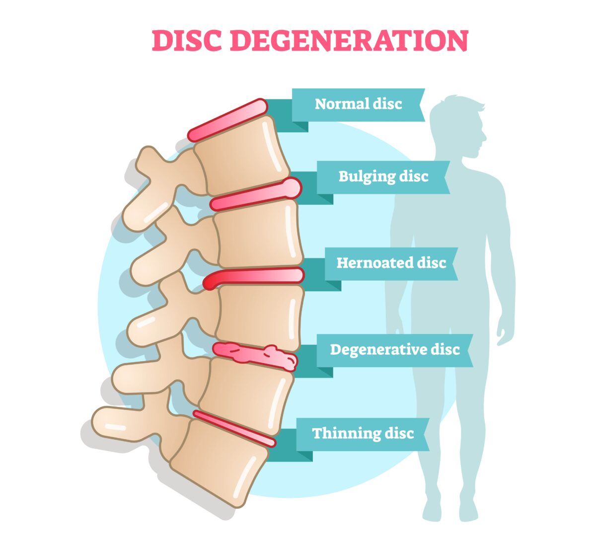 Degenerative disc disease