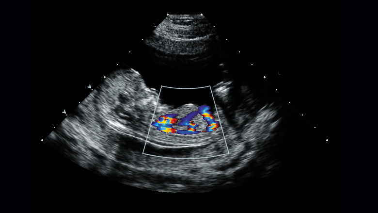 Fetal echocardiography