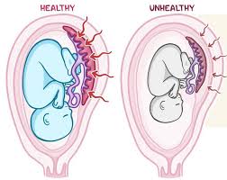 Fetal growth restriction