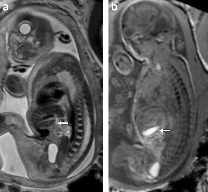 Fetal magnetic resonance imaging (MRI)