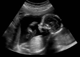 Fetal ultrasound