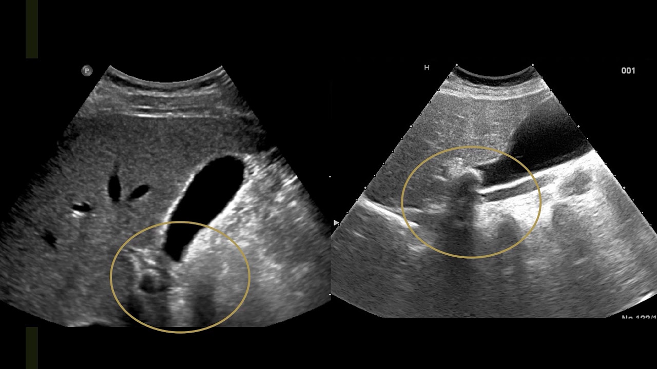 Gallbladder ultrasound