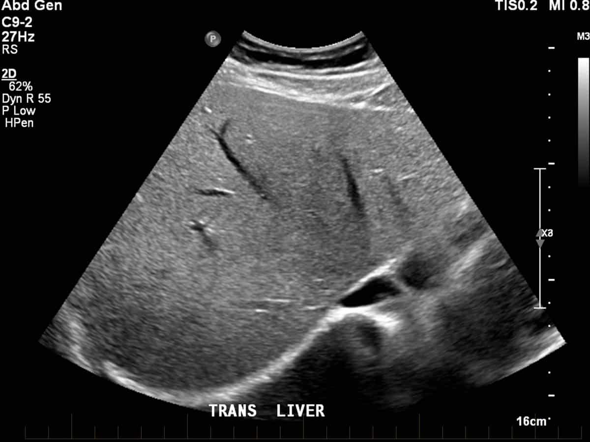 Liver ultrasound