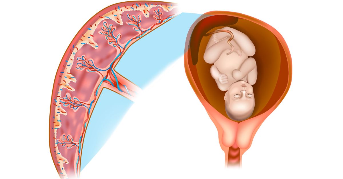 Placental disorders