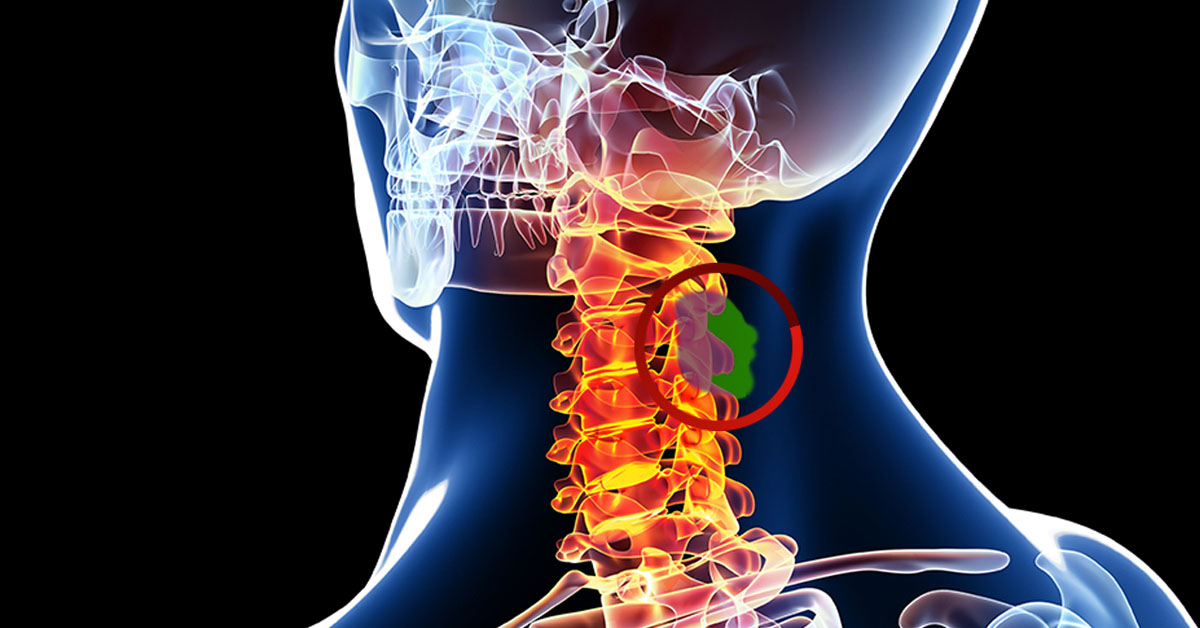 Spinal tumors