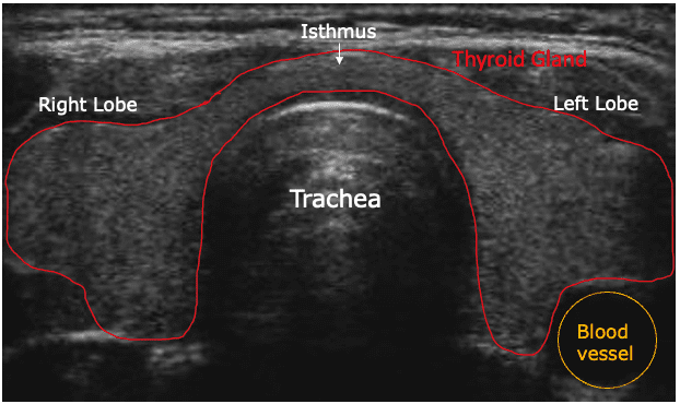 Thyroid ultrasound