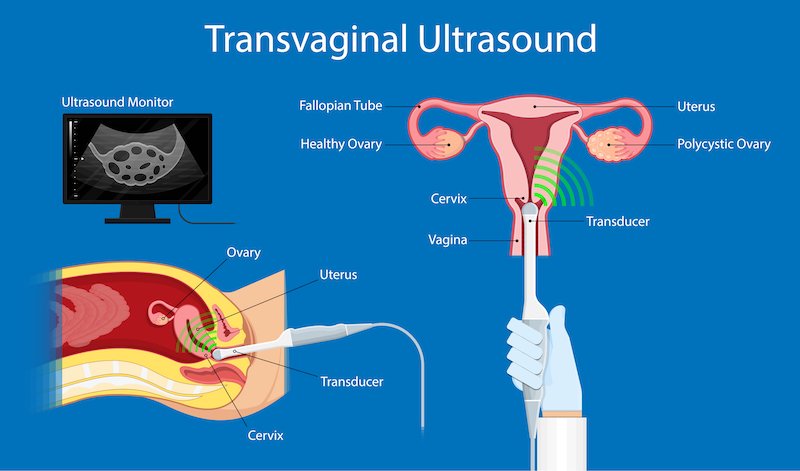 Transvaginal ultrasound