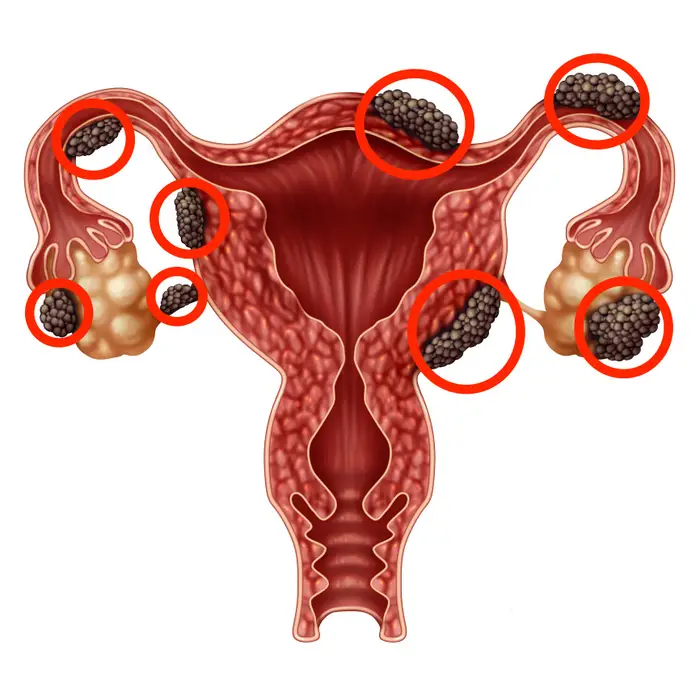 endometriosis.