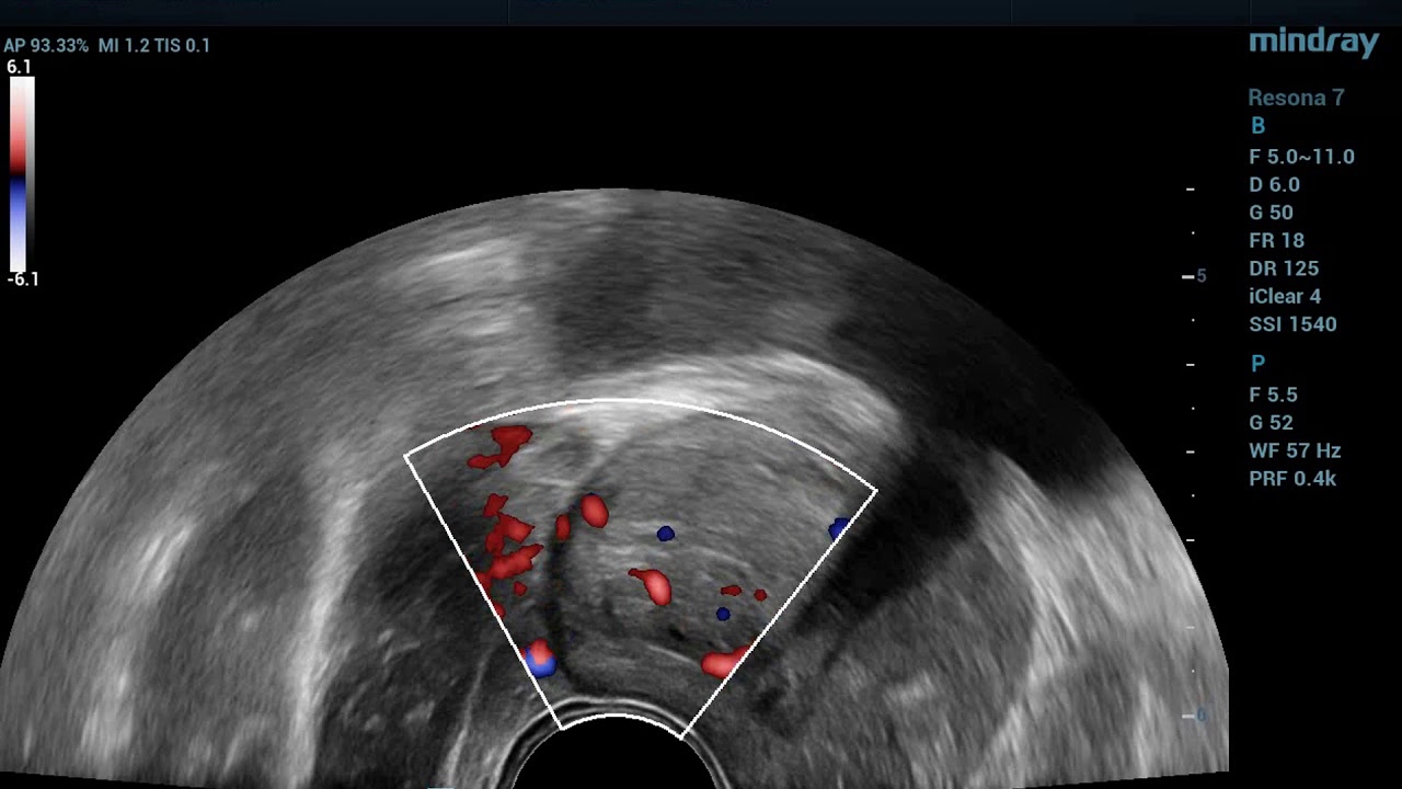 prostate ultrasound