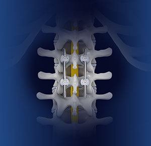 Spinal fusion