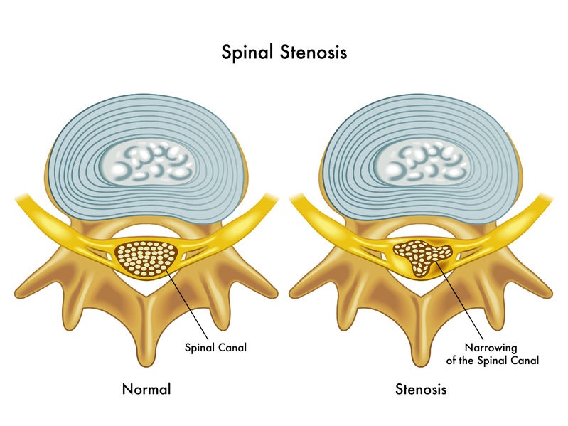 Spinal stenosis