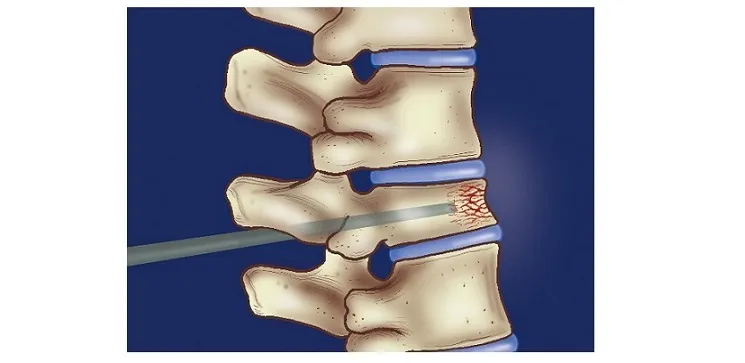 Vertebroplasty